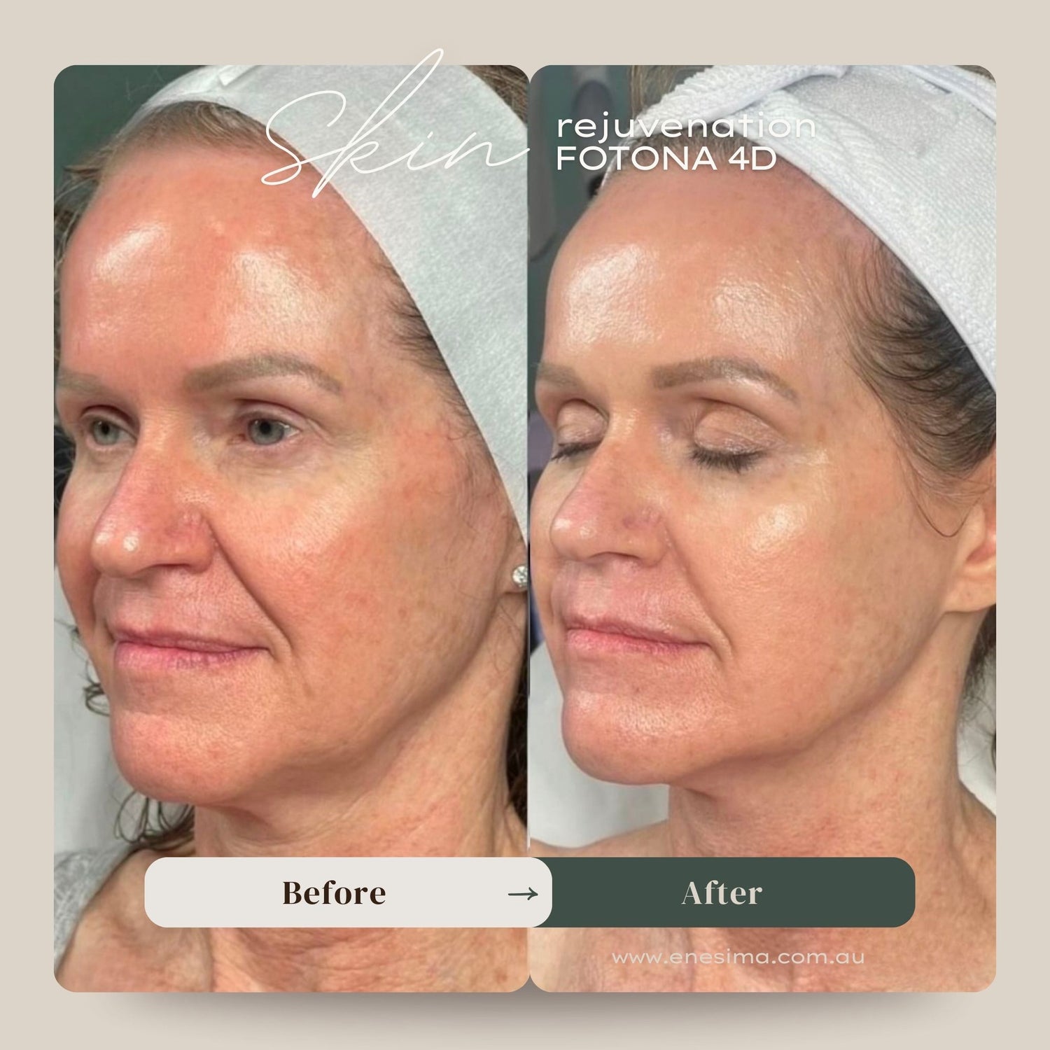 4D Face Tightening Malvern