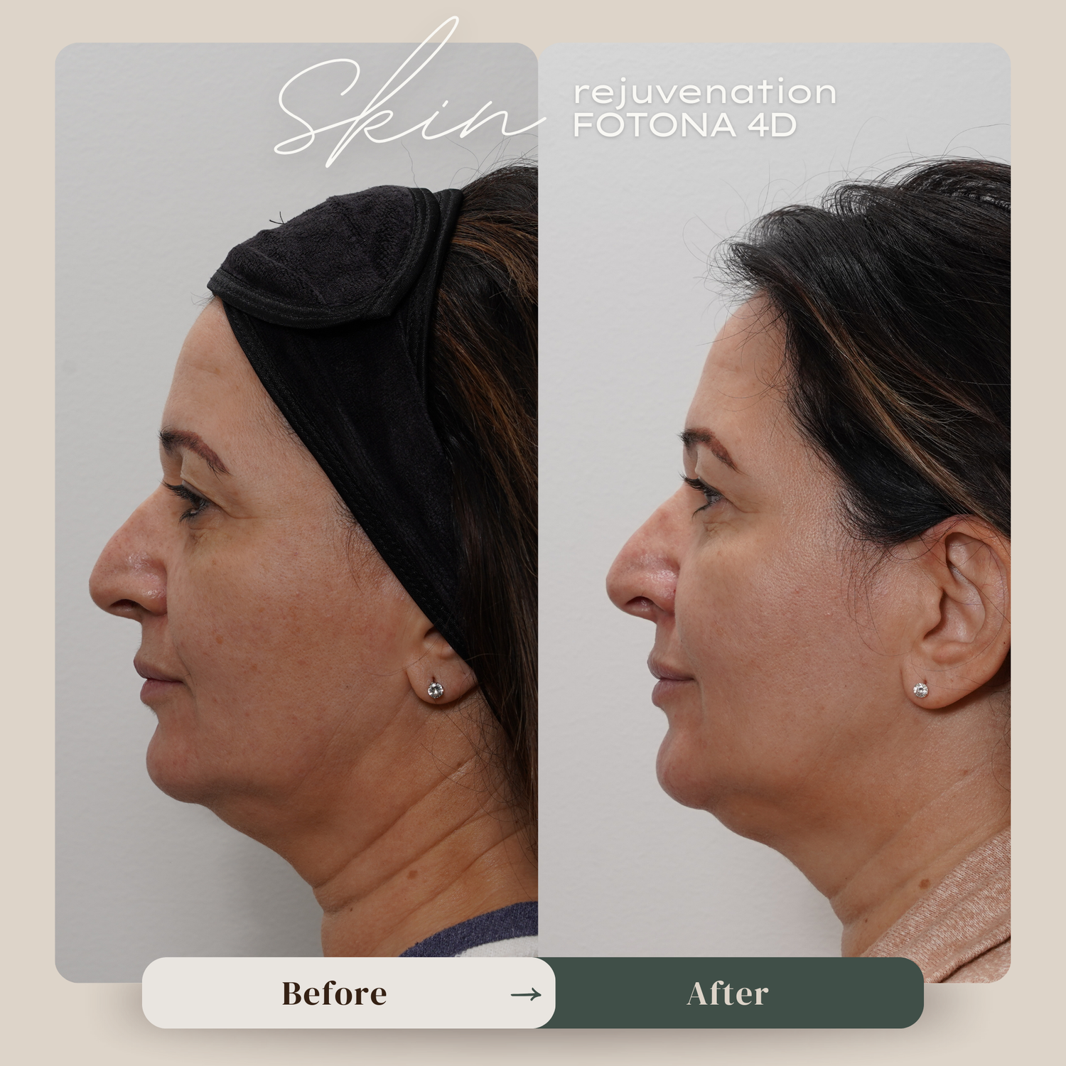 FOTONA 4D LASER FACE & NECK LIFT