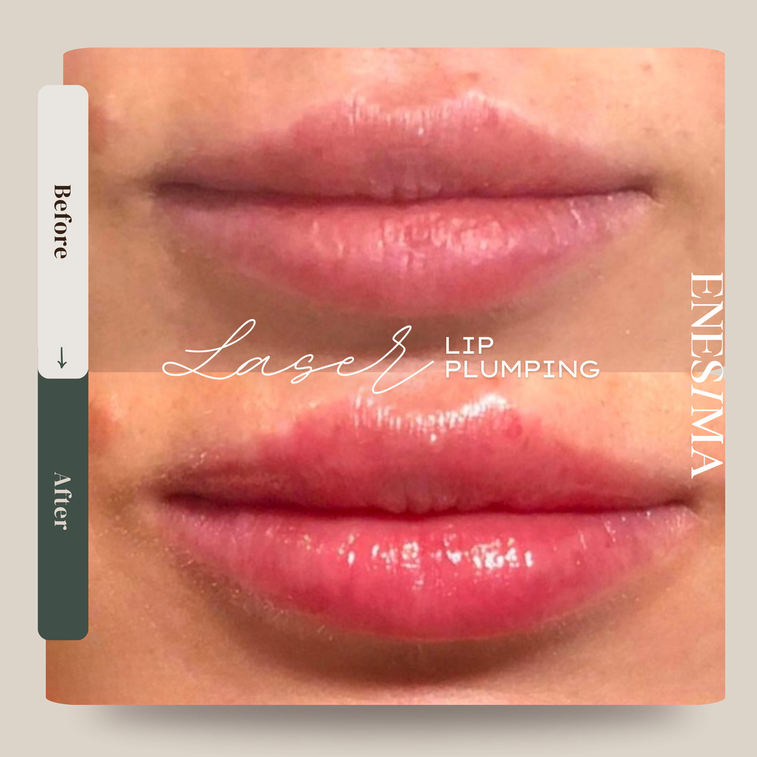 LASER LIP PLUMPING